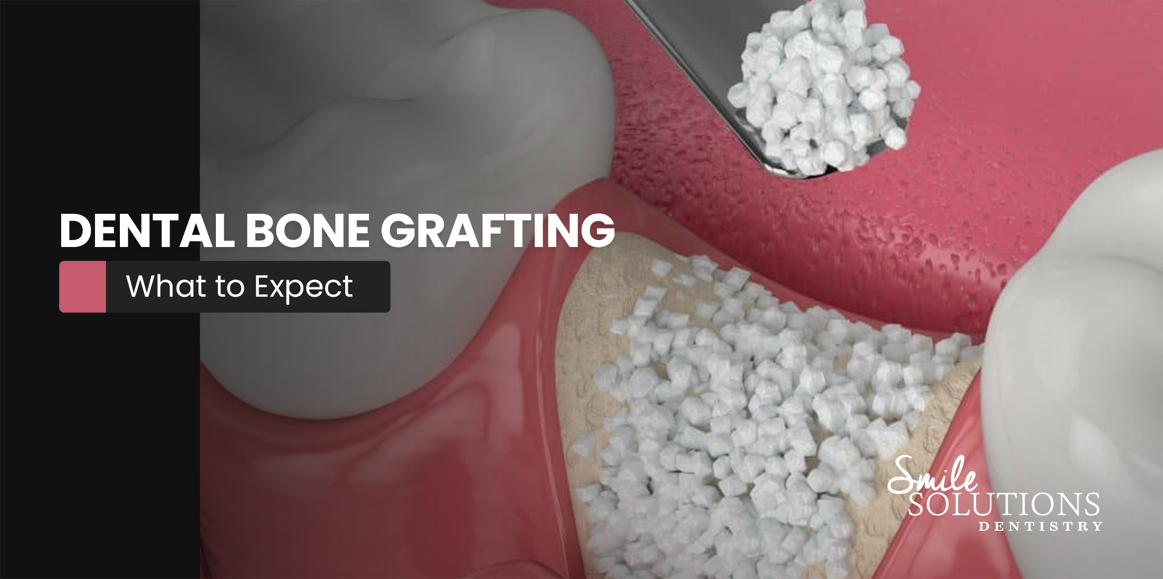 What to Expect with Dental Bone Grafting